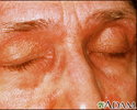 Dermatomyositis, heliotrope eyelids
