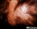 Folliculitis - decalvans on the scalp