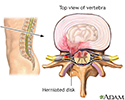 Herniated disk