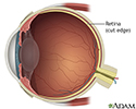 Retinal detachment repair  - series