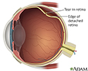 Detached retina