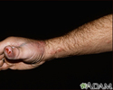 Sporotrichosis on the hand and arm