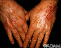 Skin cancer, squamous cell on the hands