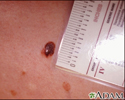 Skin cancer, close-up of level III melanoma