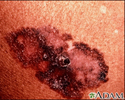 Skin cancer, melanoma superficial spreading