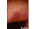 Kaposi's sarcoma on the thigh