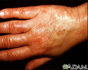 Vasculitis, urticarial on the hand