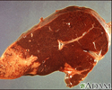 Hodgkin's disease, liver involvement