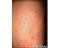 Hives (urticaria) on the back