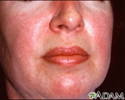 Dermatomyositis - heliotrope rash on the face