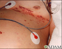 Herpes zoster (shingles), disseminated