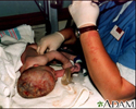 Cuidado del neonato después del parto
