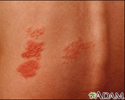 Herpes zoster (shingles) on the back