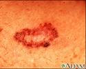Basal cell carcinoma - close-up