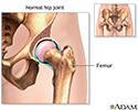 Hip joint replacement  - series