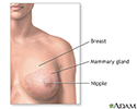 Breast lump removal  - series