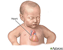Patent ductus arteriosis (PDA) - series - Infant heart anatomy