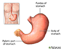 Gastrectomy  - series
