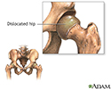Congential hip dislocation