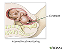 Internal fetal monitoring