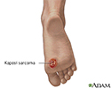 Kaposi's sarcoma on foot