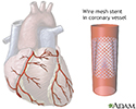 Coronary artery stent