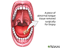 Tongue biopsy