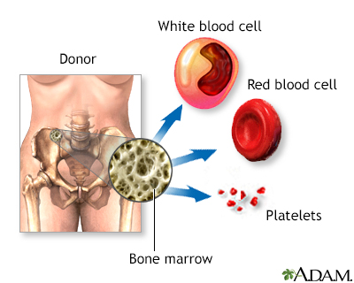 National Cancer Institute - What are bone marrow transplantation and  peripheral blood stem cell transplantation? These procedures restore stem  cells that have been destroyed by high doses of chemotherapy and/or  radiation therapy