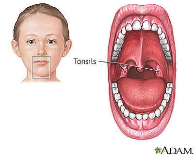 Tonsillectomy Information Mount Sinai New York