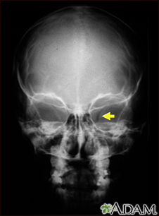 Neurofibromatosis I - enlarged optic foramen - Illustration Thumbnail              