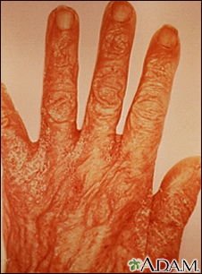 Scabies rash and excoriation on the hand