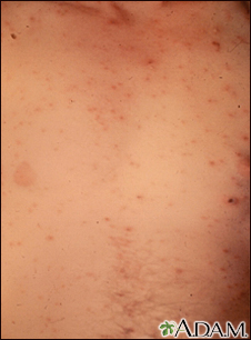 Chickenpox - lesions on the chest