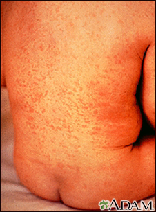 Rubella on an infant's back