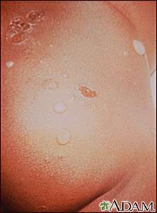 impetigo in adults legs