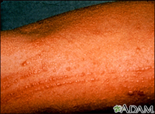 Poison oak rash on the arm - Illustration Thumbnail
                      