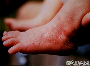 Common Rashes That Can Cause Foot Pain and Irritation - Walkrite Foot Clinic