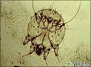Scabies mite - photomicrograph - Illustration Thumbnail
              