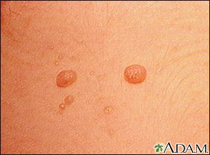 Molluscum contagiosum - close-up - Illustration Thumbnail              