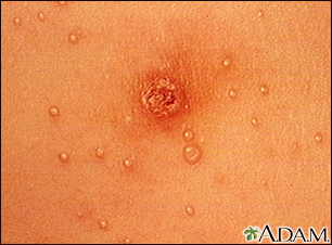 molluscum contagiosum in children