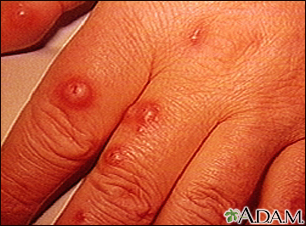 Cryptococcus - cutaneous on the hand - Illustration Thumbnail
                      