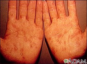 Syphilis Rash l Signs and Symptoms