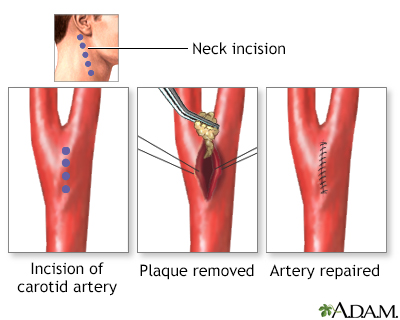 Procedure