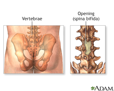 Meningocele repair - series - Presentation Thumbnail              