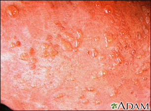 Dermatitis, herpetiformis - close-up of lesion - Illustration Thumbnail
              
