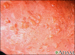 dermatitis herpetiformis neck