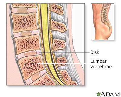 Spinal bone graft - series