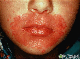 Candidiasis, cutaneous - around the mouth - Illustration Thumbnail
                      