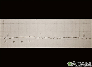 Atrioventricular block - ECG tracing - Illustration Thumbnail              