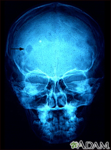 Eosinophilic granuloma - X-ray of the skull - Illustration Thumbnail
              