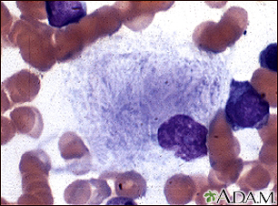 Gaucher cell - photomicrograph